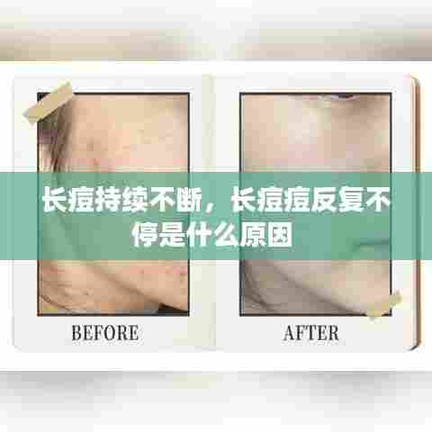 长痘持续不断，长痘痘反复不停是什么原因 