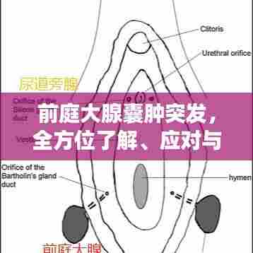 前庭大腺囊肿突发，全方位了解、应对与预防策略