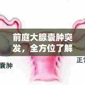 前庭大腺囊肿突发,全方位了解、应对与预防策略