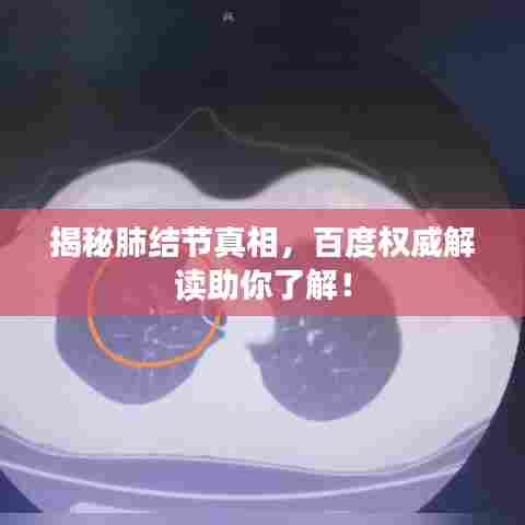 揭秘肺结节真相，百度权威解读助你了解！