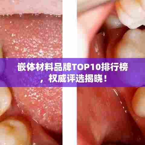 嵌体材料品牌TOP10排行榜，权威评选揭晓！